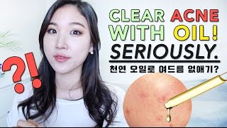 CLEAR ACNE WITH OIL • BEST Oils for Acne Prone Skin [upl. by Red188]