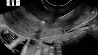 IUD on ultrasound  Jefferson hospital [upl. by Airpac]