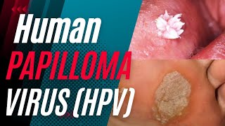 Human Papilloma Virus HPV  Signs Symptoms Causes treatment and Can it be Cured [upl. by Danie319]