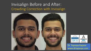 Invisalign Before and After Correction of Crowding [upl. by Netaf]