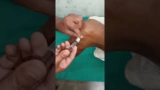 IntraArticular injection How to inject knee joint [upl. by Drue229]