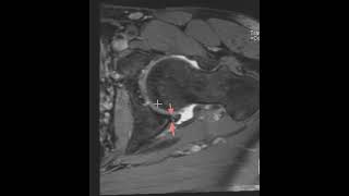 Acetabular labral tear and posterior acetabular rim fracture [upl. by Grussing]