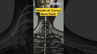 Maladie de CharcotMarieTooth marietooth maladiedecharcot charcotmarietooth neurodegenerative [upl. by Barta761]