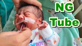 Nasogastric NG Tube Insertion in NeonateNewborn  Orogastric OG TubeFeeding Tube  Paediatric [upl. by Liagiba]