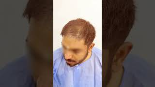 Incredible Hair Transplant Before amp After Dr Amit Kerure Hair Transplant Clinic Navi Mumbai [upl. by Htebi]