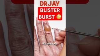 The Science of Popping Blisters [upl. by Eenafit78]