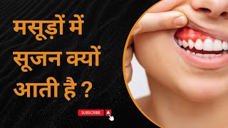 मसूड़ों में सूजन क्यों आती है   जिंजिवाइटिस क्या है   Gingivitis in Hindi [upl. by Enailil443]