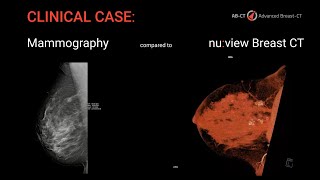 Breast CT in comparison to Mammography [upl. by Clarice]