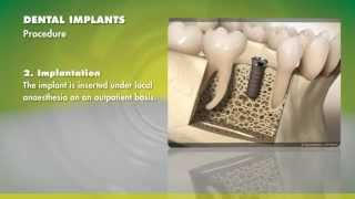 Straumann Dental Implants  Tricare [upl. by Asenad]