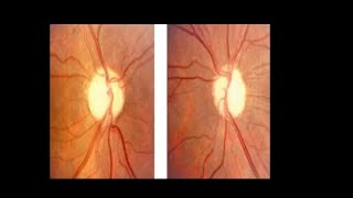 Optic atrophy Primary Secondary glaucomatous optic atrophy AnterogradeRetrograde AION RNFL [upl. by Enyalb]