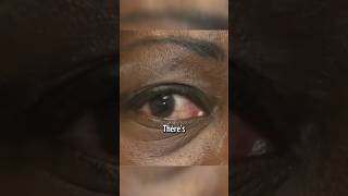 RED EYE Disease wash hands avoid touching eyes seek helphealth [upl. by Etnoek]