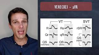 Como diagnosticar taquicardia ventricular de forma prática com Vereckei [upl. by Annawot570]