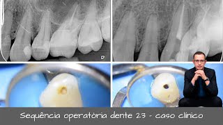 Tratamento de canal  Endodontia Avançada  Dente 23  Microscopia Operatória [upl. by Nnaeerb]