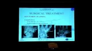 Arthroscopic Scaphoid Trapezium Trapezoid arthritis treatment [upl. by Ittap]