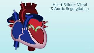 Rheumatic Heart Disease by E Rusingiza  OPENPediatrics [upl. by Ynomrah854]