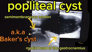 Popliteal Cysts Bakers Cysts Common Findings on Ultrasoundquot [upl. by Warthman]