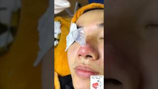 Inflamed Acne on Nose shorts pimple acne acneking [upl. by Hceicjow]