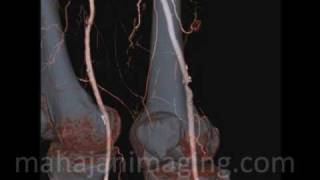 Lower Limb CT Angiography [upl. by Arikahs]