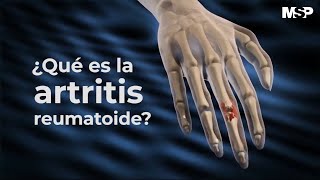 Artritis Reumatoide  ExclusivoMSP [upl. by Verdi]