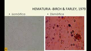 Glomerulopatias  Raciocínio Clínico  Drª Patrícia Abreu [upl. by Anirad517]