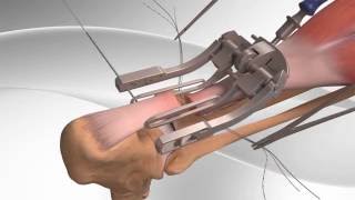 Achilles Tendon Rupture Repair with Arthrex® PARS System [upl. by Duwad]