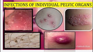 INFECTIONS OF INDIVIDUAL PELVIC ORGANS GYNAECOLOGY Dc Dutta [upl. by Rodrique94]