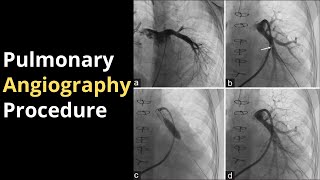 Pulmonary Angiography Procedure Angiogram Balloon Video [upl. by Rayner]