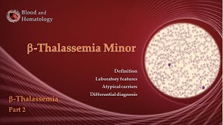 BetaThalassemia part 2  BetaThalassemia Minor [upl. by Sanfred]