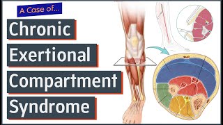 Chronic Exertional Compartment Syndrome [upl. by Lenroc]