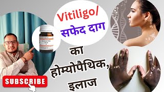 Vitiligo treatment त्वचा पर सफेद दाग का इलाज  white patches  Leucoderma treatment skin sfed dag [upl. by Enneite]