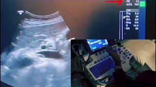 Understanding Frame Rate in Ultrasound Imaging [upl. by Oicelem996]