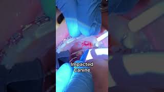 Exposed and Bond procedure  Impacted Canine  Video 6 Tooth Time Family Dentistry New Braunfels TX [upl. by Mei753]