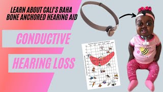 WHAT IS CONDUCTIVE HEARING LOSS  HOW DOES THE BAHA WORK LEARN ABOUT CALIS HEARING LOSS [upl. by Aryc]