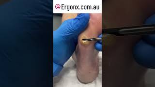 Slow motion corn and callus cutting from foot in podiatry clinic [upl. by Eremahs265]