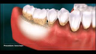 Osseous Recontouring Surgery [upl. by Nivram]