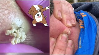 Satisfying Pimple Popping Extractions Watch the Ultimate Dermatology Delight [upl. by Stanhope]