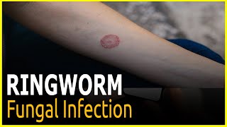 Ringworm What to know and do ringowrm treatments medicine [upl. by Hoxie286]