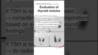 Evaluation of thyroid nodules [upl. by Lewison]