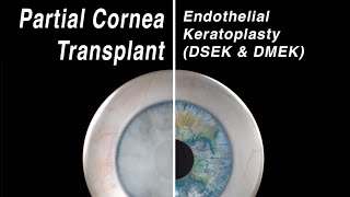 Selective Cornea Transplant  Endothelial Keratoplasty DMEK DSEK [upl. by Hort]