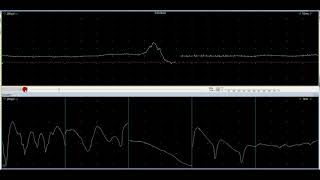 myotonic discharge [upl. by Lat]