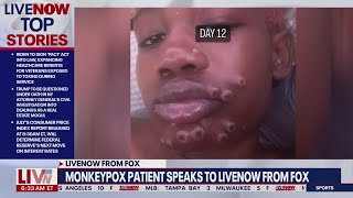 Monkeypox patient contracted virus at Georgia gas station  LiveNOW from FOX [upl. by Crysta]