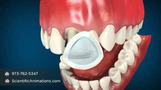 Dental Cap Procedure  Tooth Caps [upl. by Morena]