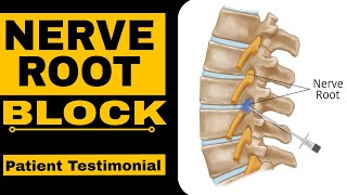 Nerve Root Block Patient Testimonial [upl. by Anett258]