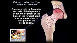 Osteonecrosis Of The Hip Stages amp Treatment  Everything You Need To Know  Dr Nabil [upl. by Eceinej213]