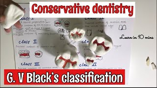 G V BLACK’S CLASSIFICATION OF TOOTH PREPARATION  CONSERVATIVE DENTISTRY  imp [upl. by Imarej]