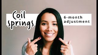 4 COIL SPRINGS  6month adjustment update  ADULT BRACES [upl. by Nhguavad]