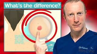 Innocent Skin Lesion or Skin Cancer What should you do [upl. by Naryk]