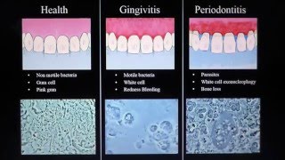 Health Gingivitis Periodontitis Mark Bonner dmd [upl. by Einohtna]