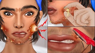 ASMR Popping pustule in jawline and face shaving Squeeze acne animation [upl. by Ecirtnahc]