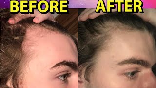 HYPERRESPONDER To Minoxidil REVERSES Hair Loss In 3 Months and Obtains FEMININE Hairline [upl. by Harifaz]